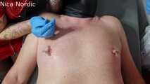 Nippelqual mit Nadeln