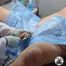 Hanna Engelss - Catheter in and urine out! Short bladder irrigation treatment