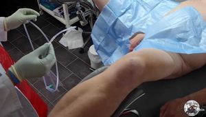 Hanna Engelss - Catheter in and urine out! Short bladder irrigation treatment